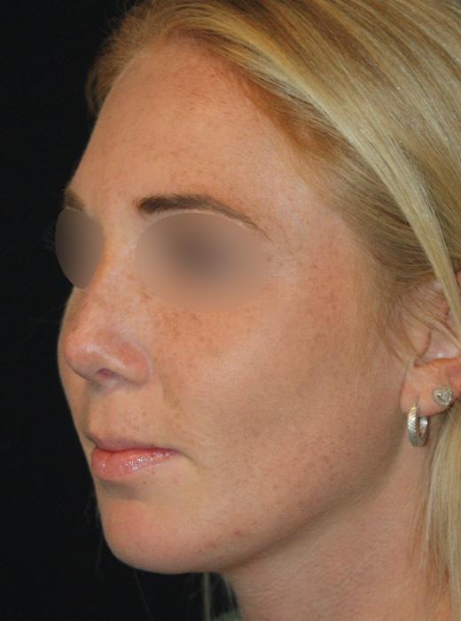 Zuliani Facial Aesthetics: Dr. Giancarlo F. Zuliani, MD rhinoplasty after — Bloomfield Hills, MI