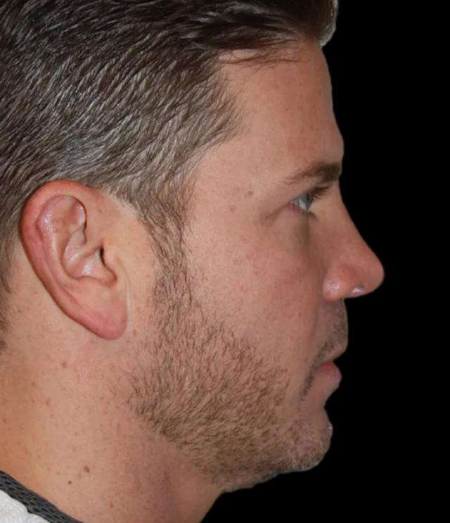 Blepharoplasty after at Zuliani Facial Aesthetics: Dr. Giancarlo F. Zuliani, MD in Bloomfield Hills, MI