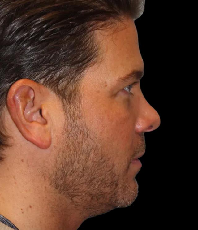 Blepharoplasty before at Zuliani Facial Aesthetics: Dr. Giancarlo F. Zuliani, MD in Bloomfield Hills, MI