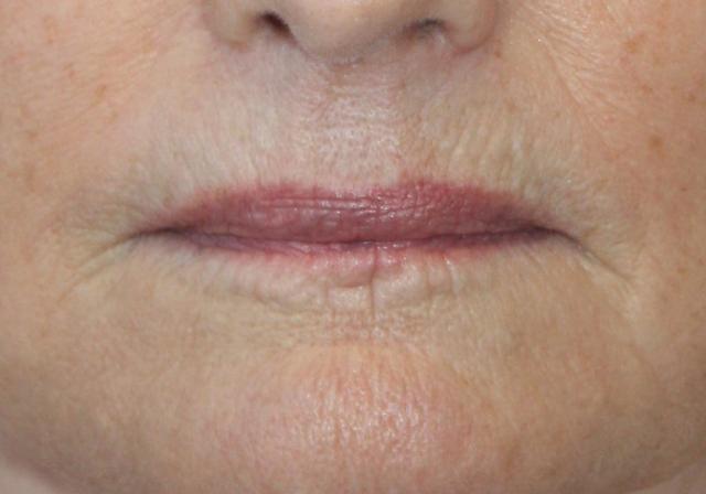 Laser Skin Resurfacing before at Zuliani Facial Aesthetics: Dr. Giancarlo F. Zuliani, MD in Bloomfield Hills, MI