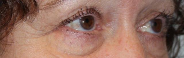 Blepharoplasty before at Zuliani Facial Aesthetics: Dr. Giancarlo F. Zuliani, MD in Bloomfield Hills, MI