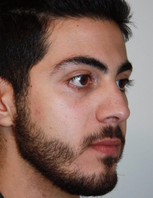 Rhinoplasty after at Zuliani Facial Aesthetics: Dr. Giancarlo F. Zuliani, MD in Bloomfield Hills, MI