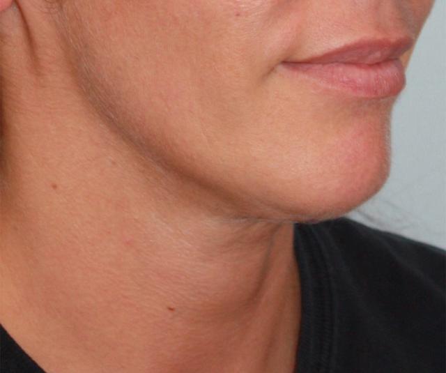 Neck Lift after at Zuliani Facial Aesthetics: Dr. Giancarlo F. Zuliani, MD in Bloomfield Hills, MI