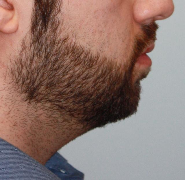 Neck Liposuction before at Zuliani Facial Aesthetics: Dr. Giancarlo F. Zuliani, MD in Bloomfield Hills, MI