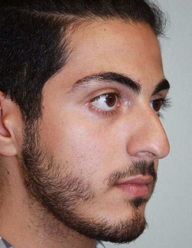 Rhinoplasty before at Zuliani Facial Aesthetics: Dr. Giancarlo F. Zuliani, MD in Bloomfield Hills, MI