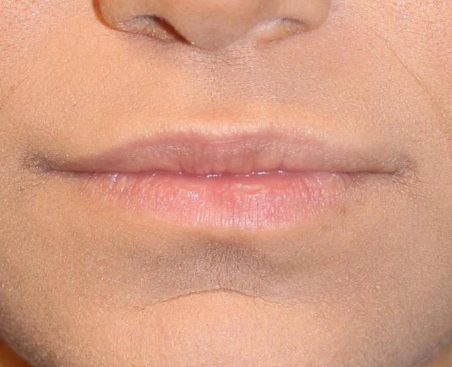 Dermal Fillers before at Zuliani Facial Aesthetics: Dr. Giancarlo F. Zuliani, MD in Bloomfield Hills, MI