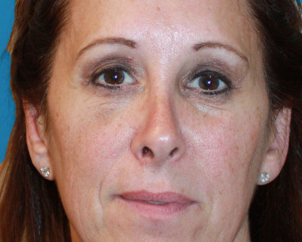 Zuliani Facial Aesthetics: Dr. Giancarlo F. Zuliani, MD blepharoplasty after — Bloomfield Hills, MI