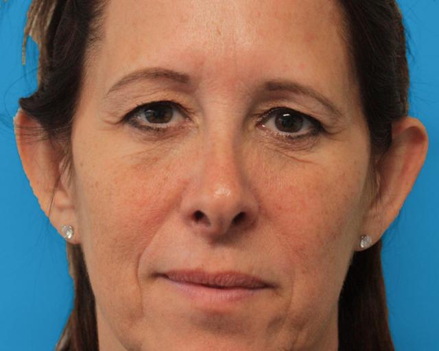 Blepharoplasty before at Zuliani Facial Aesthetics: Dr. Giancarlo F. Zuliani, MD in Bloomfield Hills, MI