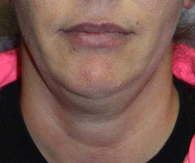 Neck Lift before at Zuliani Facial Aesthetics: Dr. Giancarlo F. Zuliani, MD in Bloomfield Hills, MI