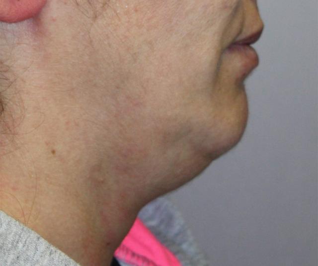 Neck Lift before at Zuliani Facial Aesthetics: Dr. Giancarlo F. Zuliani, MD in Bloomfield Hills, MI