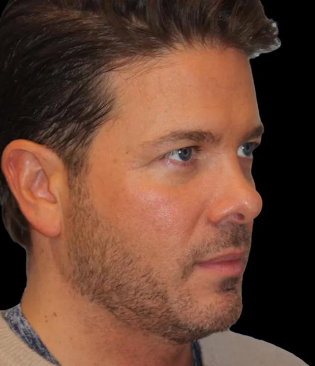 Blepharoplasty before at Zuliani Facial Aesthetics: Dr. Giancarlo F. Zuliani, MD in Bloomfield Hills, MI