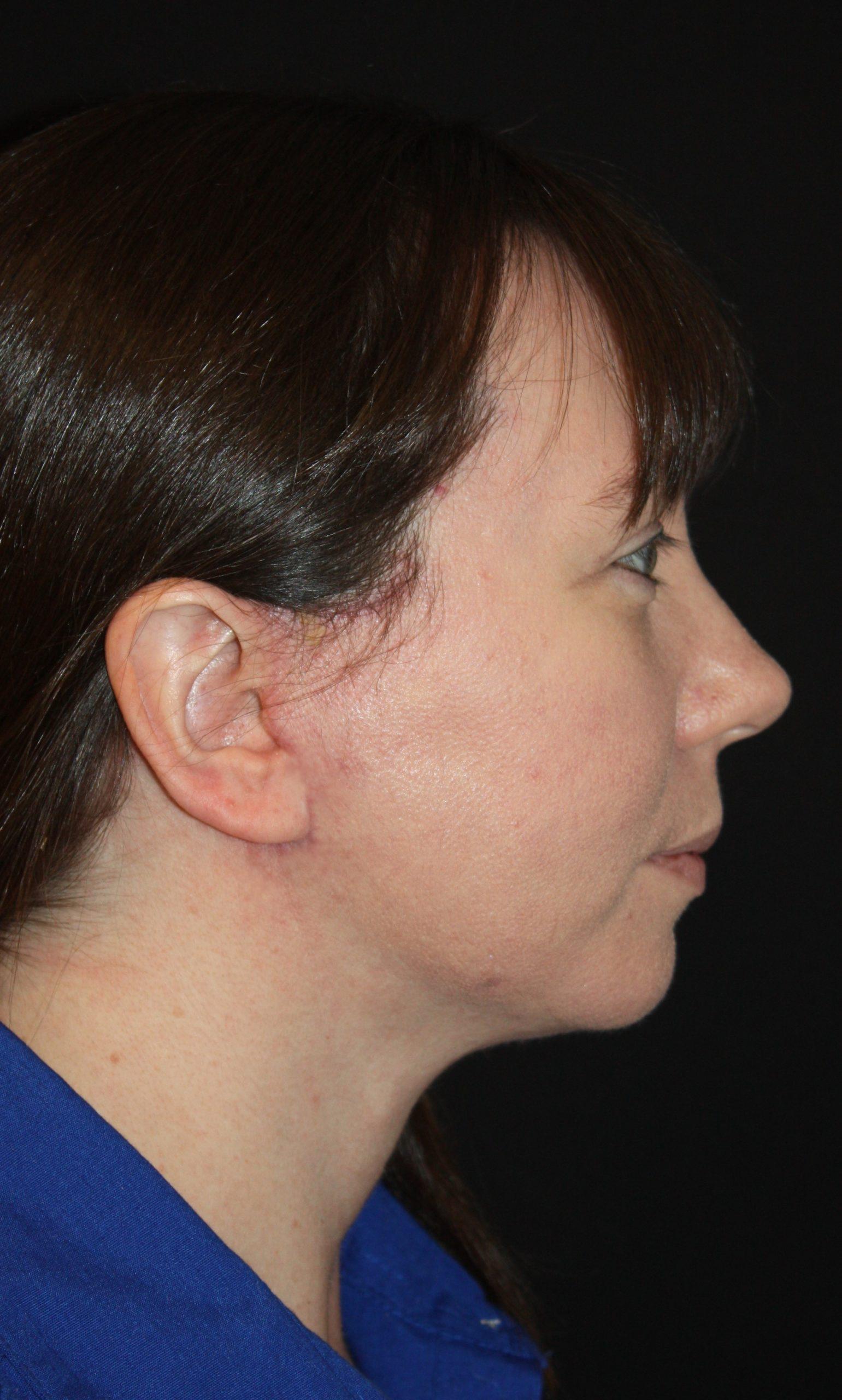 Zuliani Facial Aesthetics: Dr. Giancarlo F. Zuliani, MD facelift after — Bloomfield Hills, MI