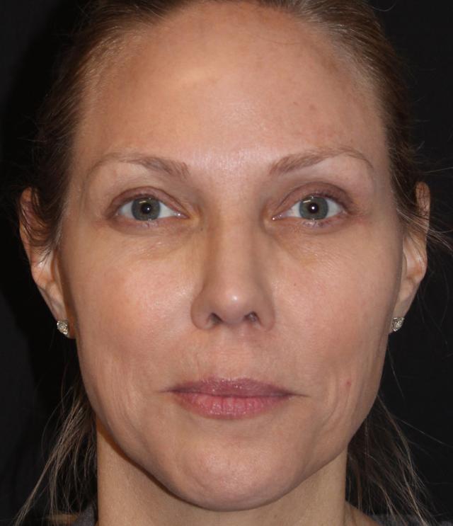 Brow Lift after at Zuliani Facial Aesthetics: Dr. Giancarlo F. Zuliani, MD in Bloomfield Hills, MI