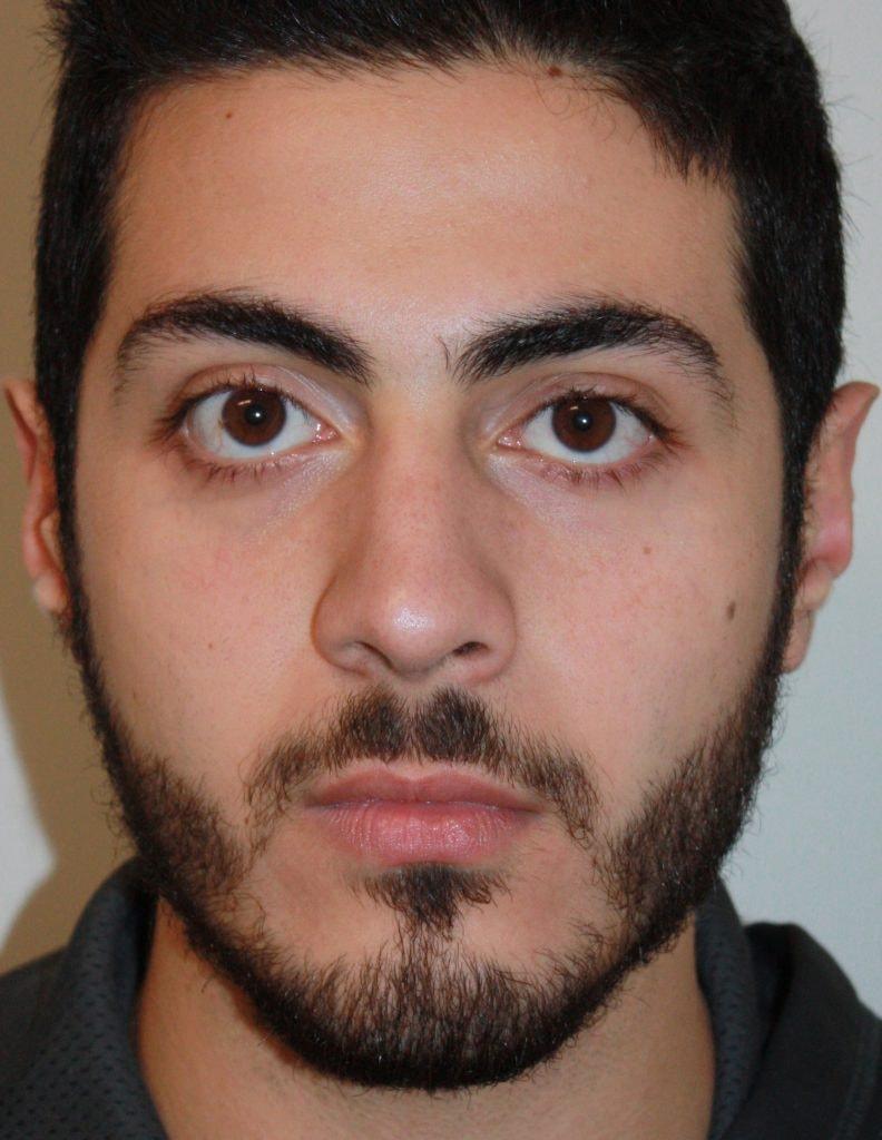 Zuliani Facial Aesthetics: Dr. Giancarlo F. Zuliani, MD rhinoplasty after — Bloomfield Hills, MI