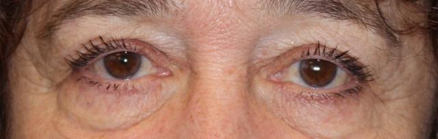 Blepharoplasty before at Zuliani Facial Aesthetics: Dr. Giancarlo F. Zuliani, MD in Bloomfield Hills, MI