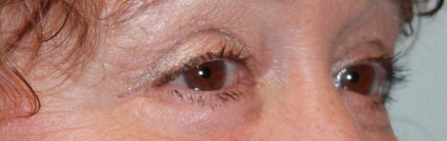 Blepharoplasty after at Zuliani Facial Aesthetics: Dr. Giancarlo F. Zuliani, MD in Bloomfield Hills, MI