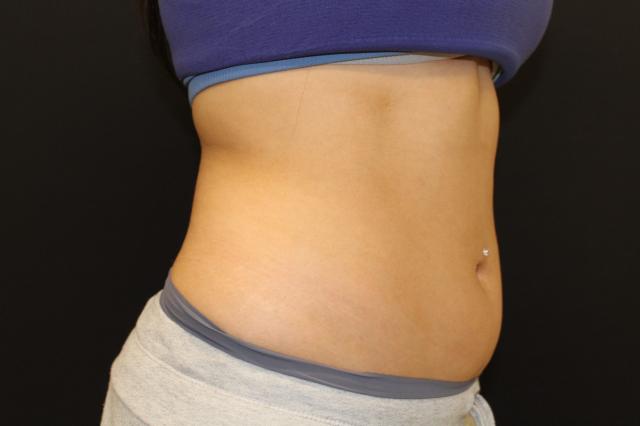 Thigh Lift before at Zuliani Facial Aesthetics: Dr. Giancarlo F. Zuliani, MD in Bloomfield Hills, MI