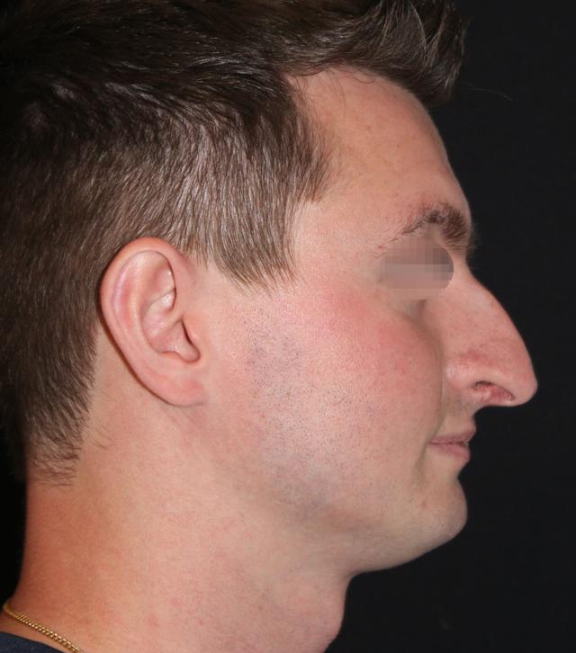 Functional Rhinoplasty before at Zuliani Facial Aesthetics: Dr. Giancarlo F. Zuliani, MD in Bloomfield Hills, MI