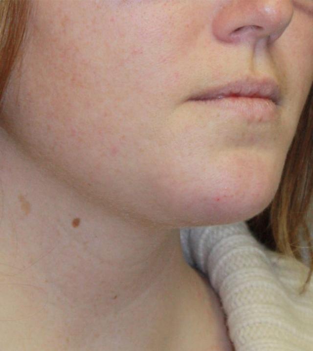 Neck Liposuction after at Zuliani Facial Aesthetics: Dr. Giancarlo F. Zuliani, MD in Bloomfield Hills, MI