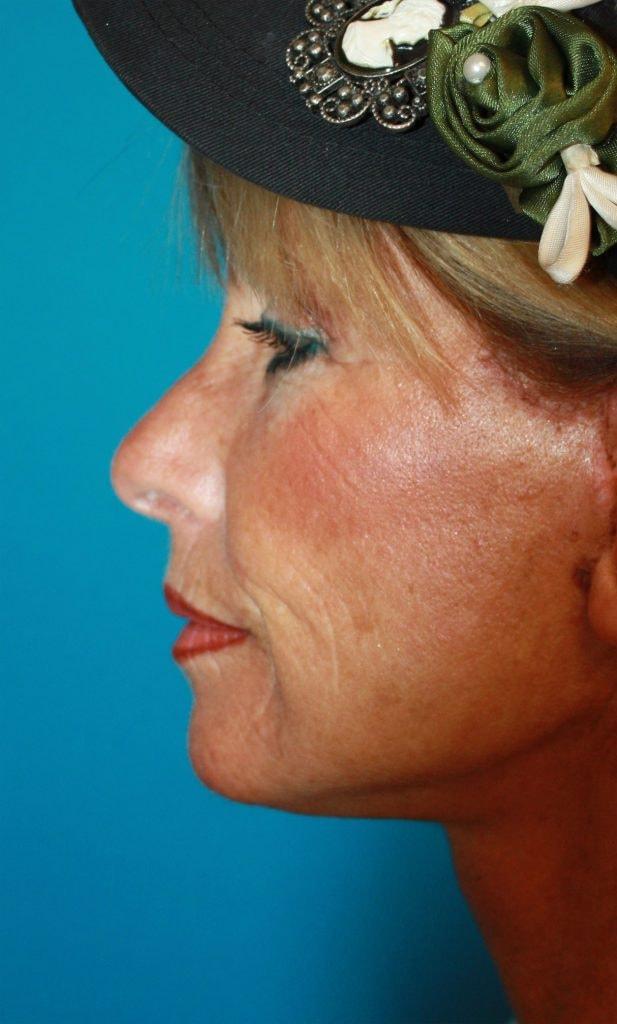 Facelift after at Zuliani Facial Aesthetics: Dr. Giancarlo F. Zuliani, MD in Bloomfield Hills, MI