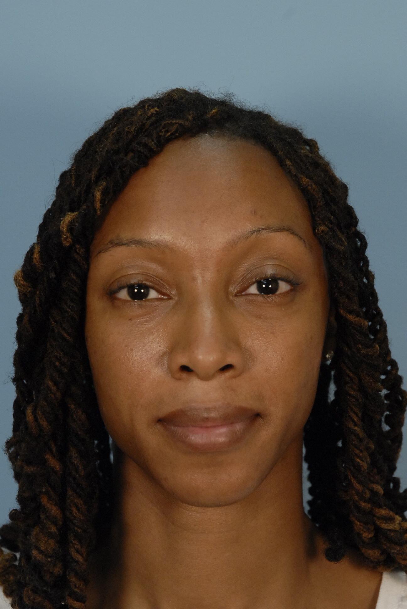 Zuliani Facial Aesthetics: Dr. Giancarlo F. Zuliani, MD blepharoplasty after — Bloomfield Hills, MI