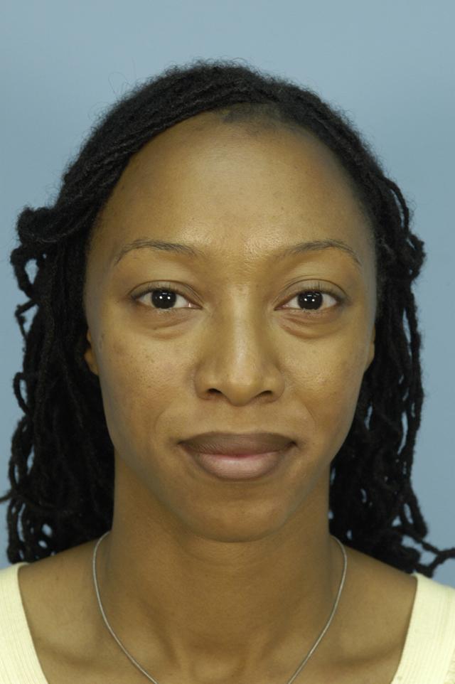 Blepharoplasty before at Zuliani Facial Aesthetics: Dr. Giancarlo F. Zuliani, MD in Bloomfield Hills, MI