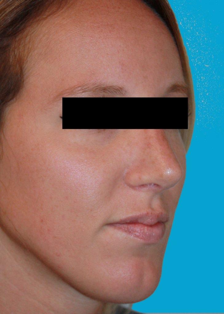 Zuliani Facial Aesthetics: Dr. Giancarlo F. Zuliani, MD rhinoplasty after — Bloomfield Hills, MI