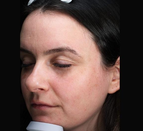 Laser Skin Resurfacing before at Zuliani Facial Aesthetics: Dr. Giancarlo F. Zuliani, MD in Bloomfield Hills, MI