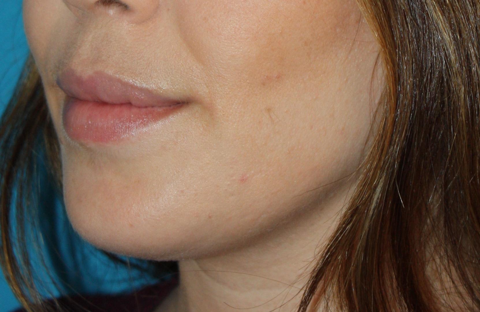 Zuliani Facial Aesthetics: Dr. Giancarlo F. Zuliani, MD facelift after — Bloomfield Hills, MI