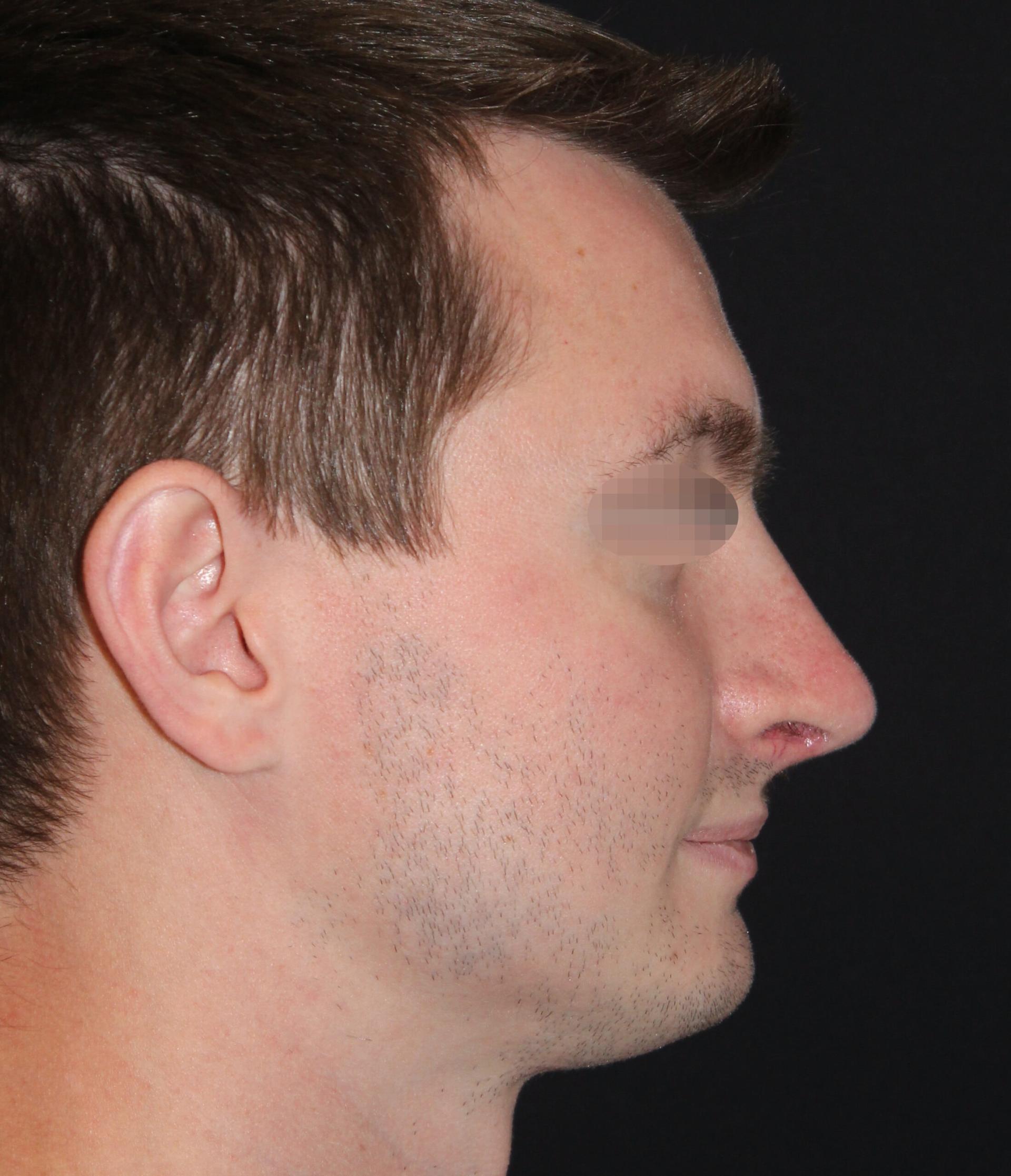Zuliani Facial Aesthetics: Dr. Giancarlo F. Zuliani, MD rhinoplasty after — Bloomfield Hills, MI