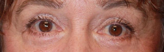 Blepharoplasty after at Zuliani Facial Aesthetics: Dr. Giancarlo F. Zuliani, MD in Bloomfield Hills, MI