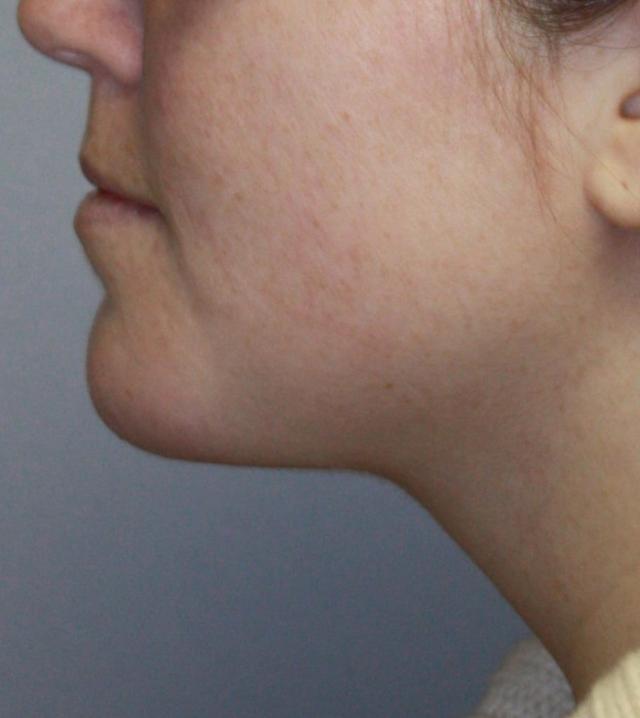 Neck Liposuction after at Zuliani Facial Aesthetics: Dr. Giancarlo F. Zuliani, MD in Bloomfield Hills, MI