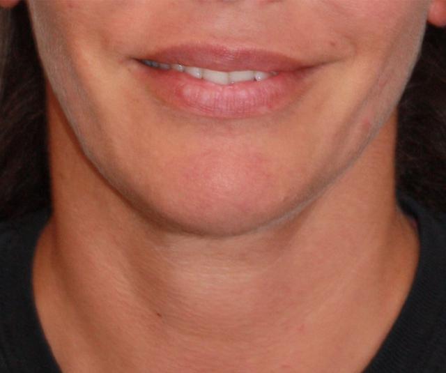 Neck Lift after at Zuliani Facial Aesthetics: Dr. Giancarlo F. Zuliani, MD in Bloomfield Hills, MI