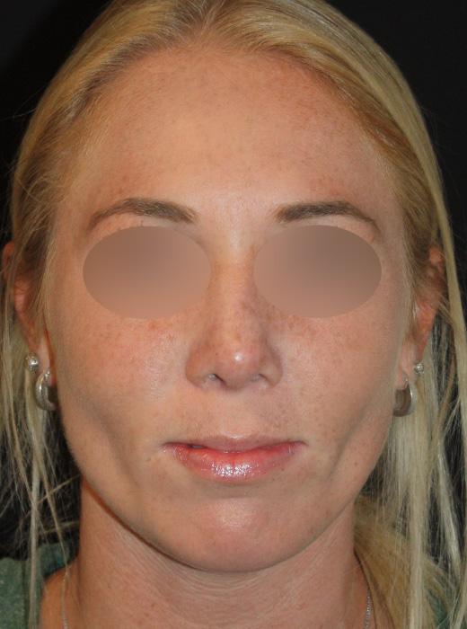 Zuliani Facial Aesthetics: Dr. Giancarlo F. Zuliani, MD rhinoplasty after — Bloomfield Hills, MI