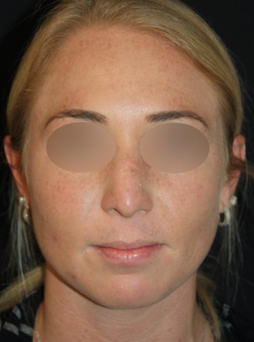 Rhinoplasty before at Zuliani Facial Aesthetics: Dr. Giancarlo F. Zuliani, MD in Bloomfield Hills, MI