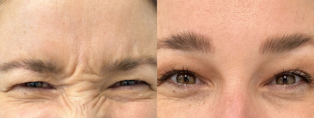 Botox result at Zuliani Facial Aesthetics: Dr. Giancarlo F. Zuliani, MD in Bloomfield Hills, MI
