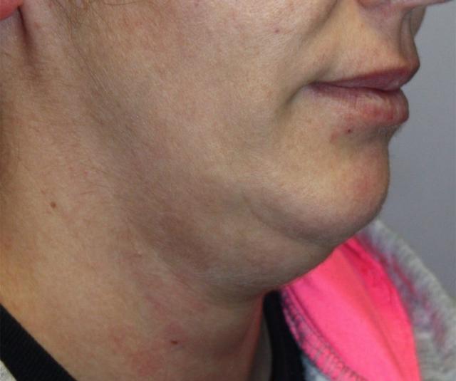 Neck Lift before at Zuliani Facial Aesthetics: Dr. Giancarlo F. Zuliani, MD in Bloomfield Hills, MI