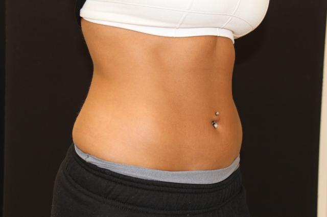 Thigh Lift after at Zuliani Facial Aesthetics: Dr. Giancarlo F. Zuliani, MD in Bloomfield Hills, MI