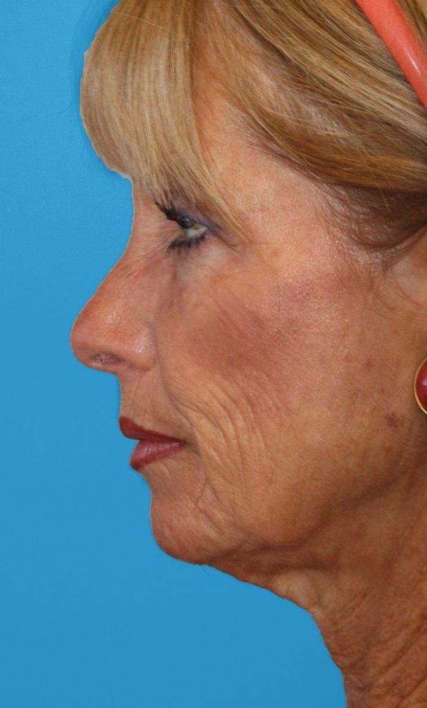 Facelift before at Zuliani Facial Aesthetics: Dr. Giancarlo F. Zuliani, MD in Bloomfield Hills, MI