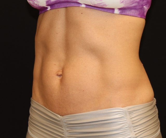 Thigh Lift after at Zuliani Facial Aesthetics: Dr. Giancarlo F. Zuliani, MD in Bloomfield Hills, MI