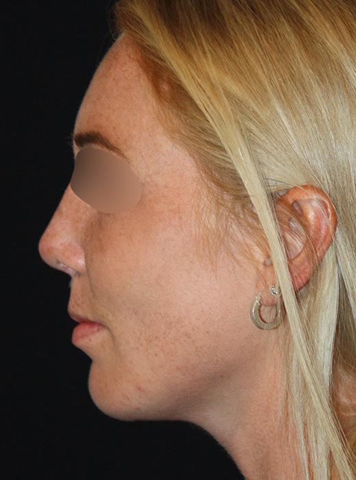 Rhinoplasty after at Zuliani Facial Aesthetics: Dr. Giancarlo F. Zuliani, MD in Bloomfield Hills, MI