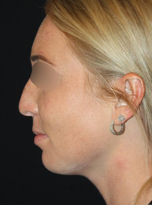 Rhinoplasty before at Zuliani Facial Aesthetics: Dr. Giancarlo F. Zuliani, MD in Bloomfield Hills, MI