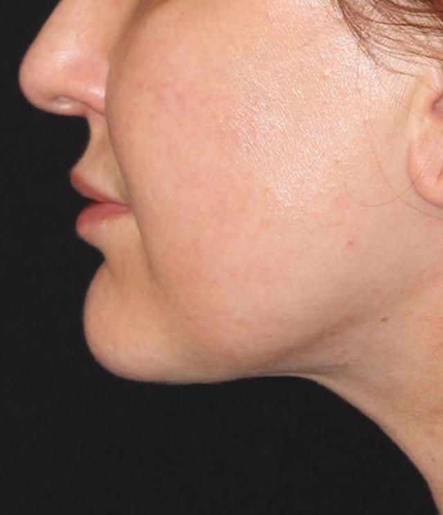 Neck Lift after at Zuliani Facial Aesthetics: Dr. Giancarlo F. Zuliani, MD in Bloomfield Hills, MI