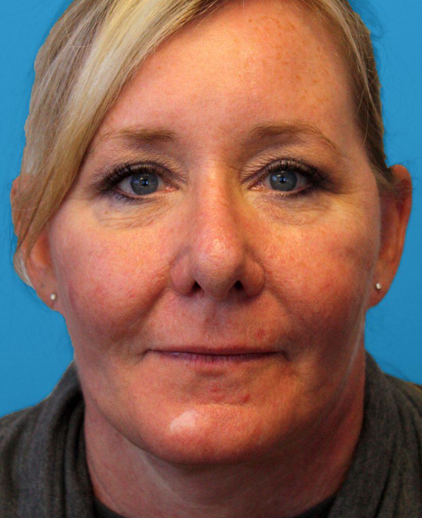 Zuliani Facial Aesthetics: Dr. Giancarlo F. Zuliani, MD facelift after — Bloomfield Hills, MI