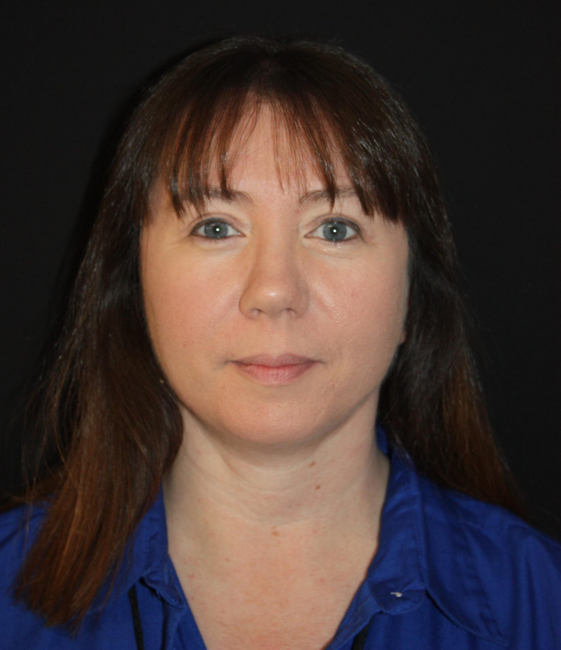 Zuliani Facial Aesthetics: Dr. Giancarlo F. Zuliani, MD facelift after — Bloomfield Hills, MI