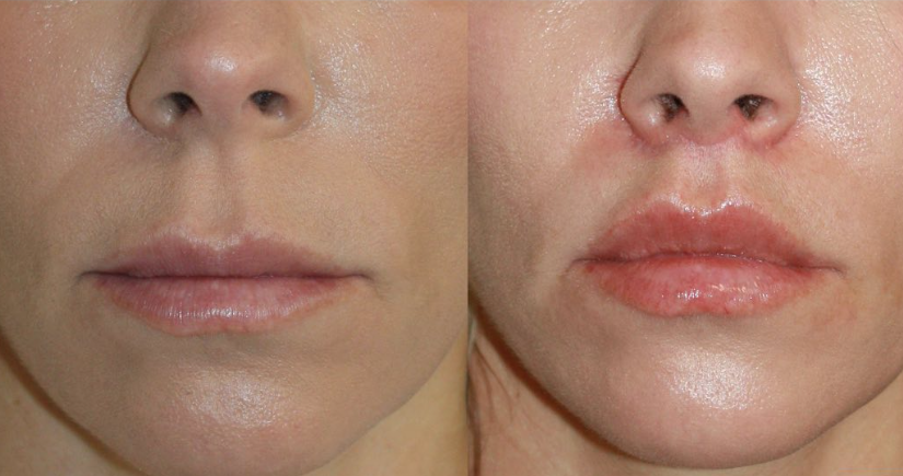 Zuliani Facial Aesthetics: Dr. Giancarlo F. Zuliani, MD lip lift result — Bloomfield Hills, MI