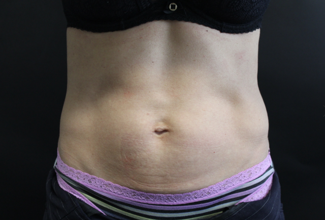 Thigh Lift before at Zuliani Facial Aesthetics: Dr. Giancarlo F. Zuliani, MD in Bloomfield Hills, MI