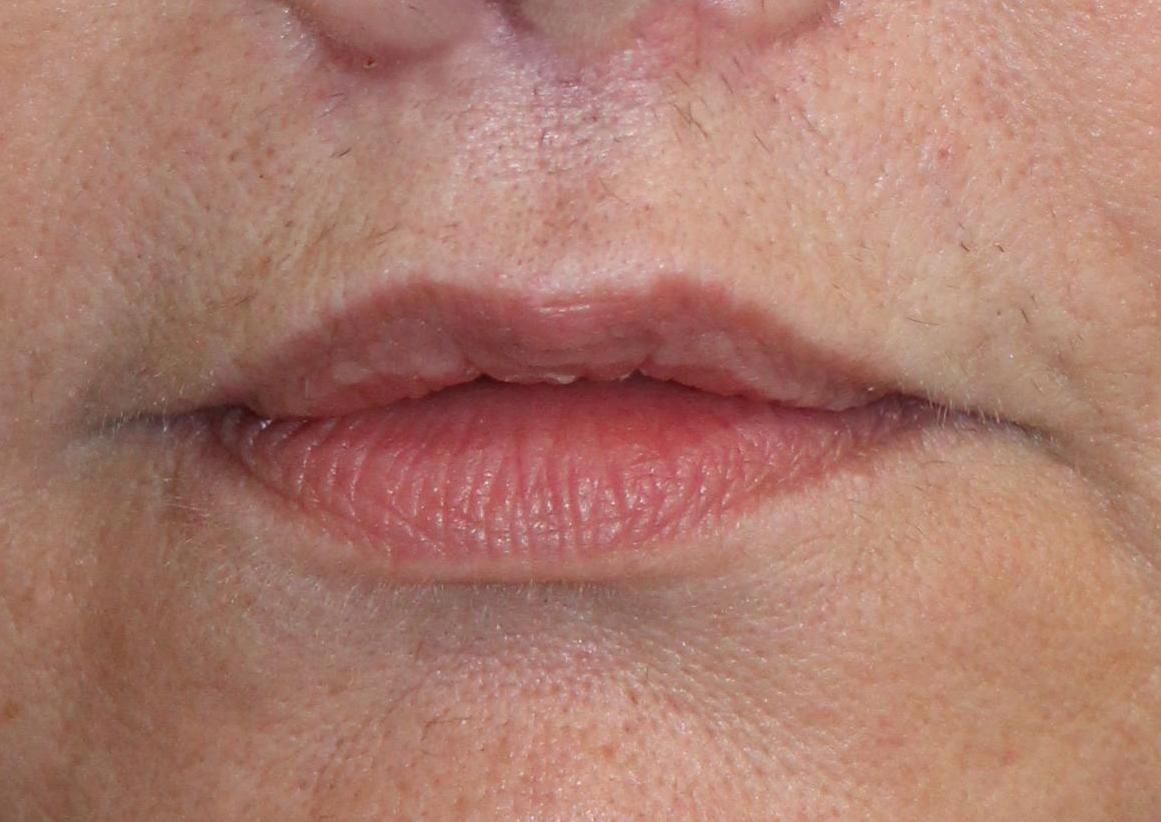 Zuliani Facial Aesthetics: Dr. Giancarlo F. Zuliani, MD facelift after — Bloomfield Hills, MI