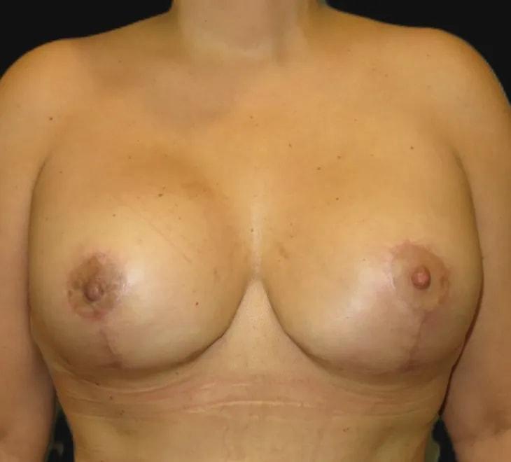 Sean Simon, MD breast augmentation revision after — Miami, FL