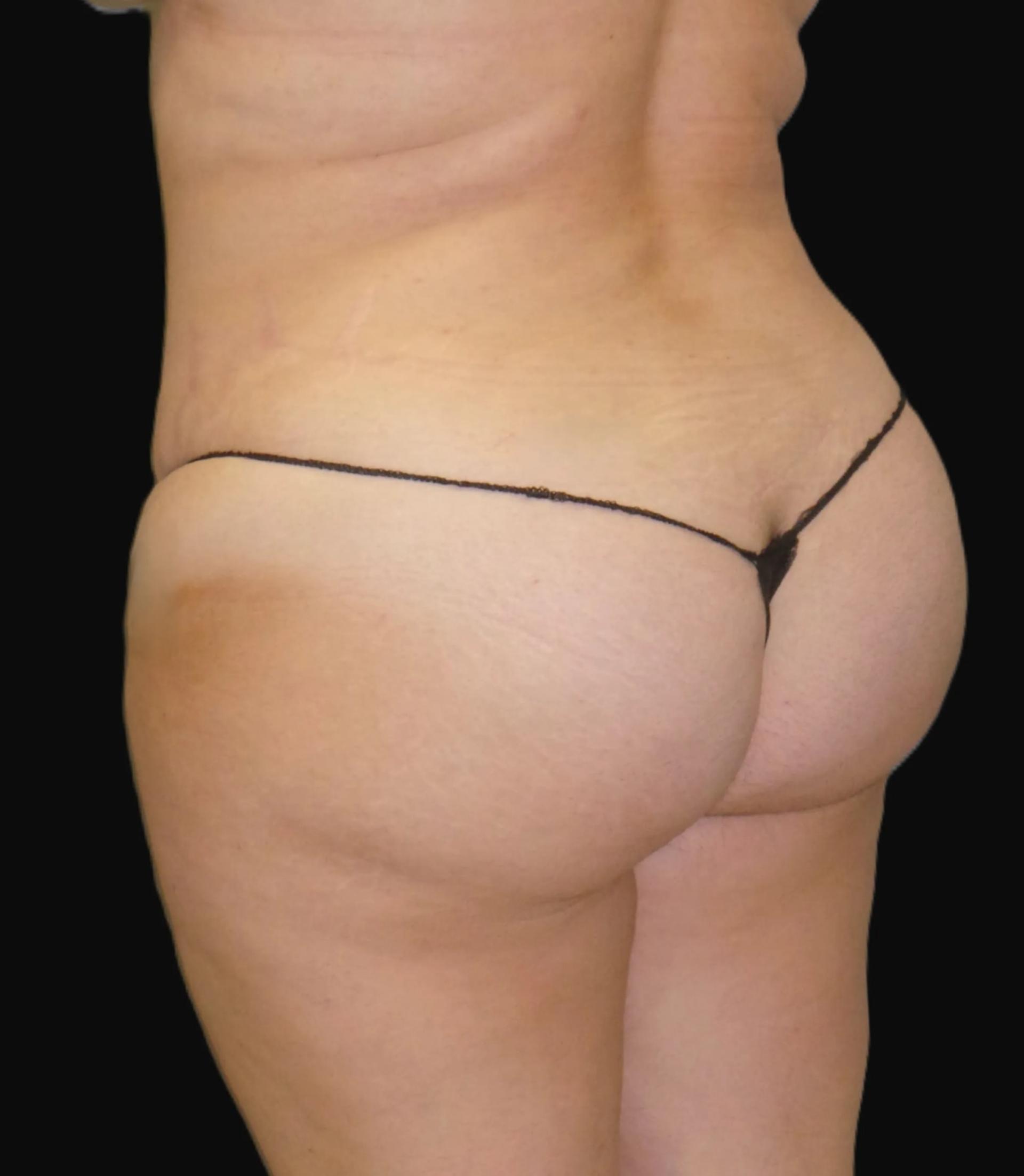 Sean Simon, MD bbl after — Miami, FL